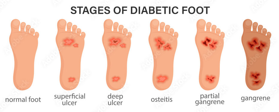 Vascular and Endovascular Surgery - Diabetic foot