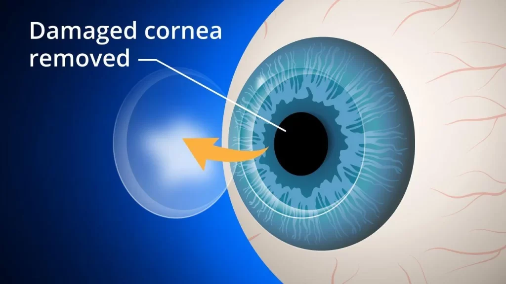 cornea transplant surgery-Holy Spirit Hospital